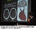 脳卒中「急性期に適切な医療を」のサムネイル画像