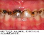 10歳で永久歯失う子も―子どもや若者に歯の「健康格差」のサムネイル画像